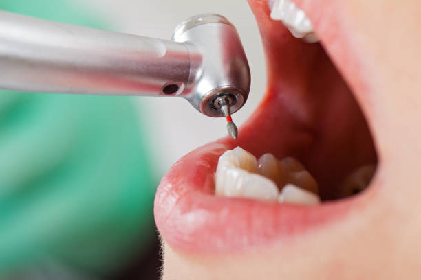 Best Emergency Wisdom Teeth Removal in Broadview Park, FL
